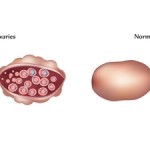 PCOS ovaries