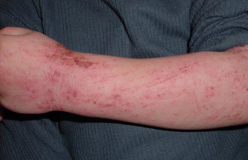 hpv vaccine skin rash)