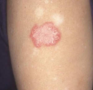 Discoid rash - Lupus