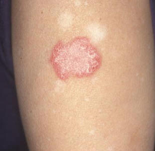 hpv dry skin patches