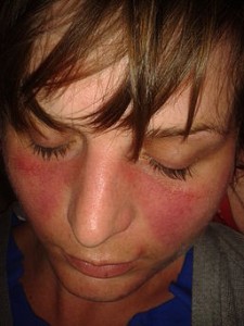 Butterfly rash - Lupus Butterfly rash - Lupus
