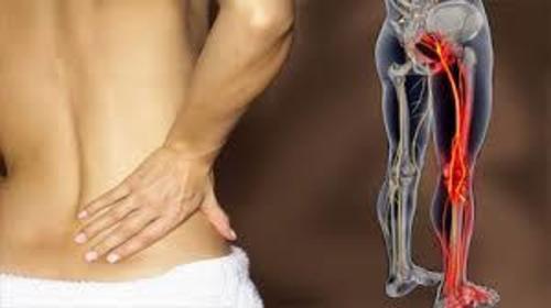 sciatic endometriosis sciatic endometriosis