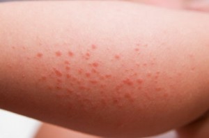 Cutaneous Lupus rash