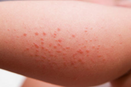 Hpv vaccine skin rash