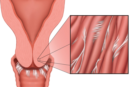 Hysterectomy Sexual Intercourse 51