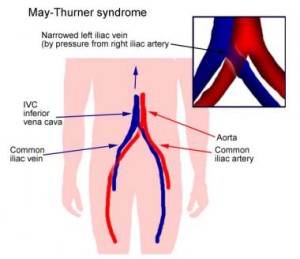 May Thurner Syndrome, Pelvic Clots