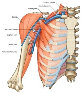 subclavian vein effort thrombosis