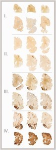 Brain damage with Traumatic Head Injury