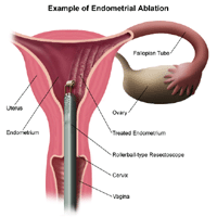 Endometrial ablation: A popular solution to abnormal bleeding for