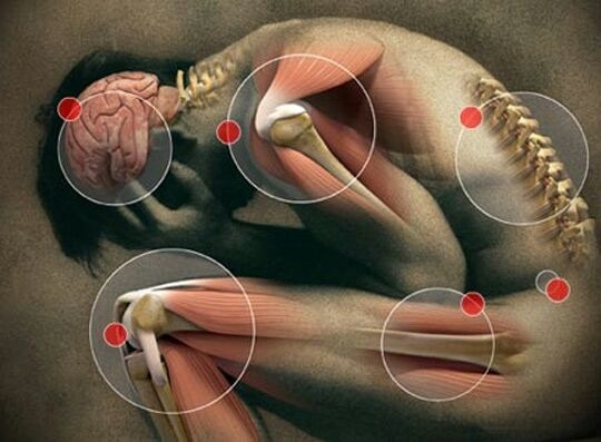 thiamine deficiency in fibromyalgia and chronic pain