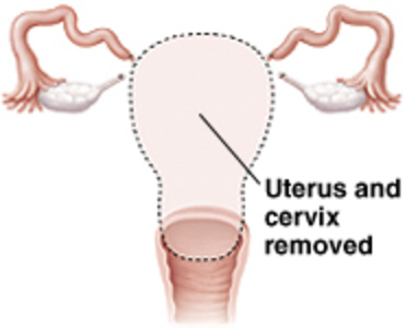 Hysterectomy And Orgasm 66