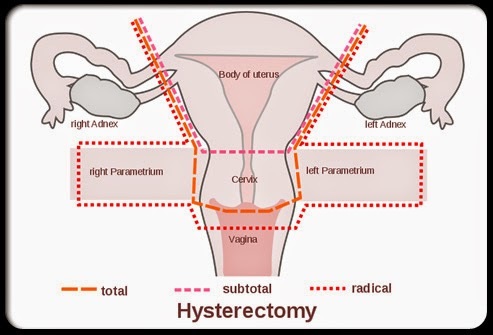 Sexual Function after Hysterectomy- Hormones Matter 493x335 pic Sexual Function after Hysterectomy- Hormones Matter