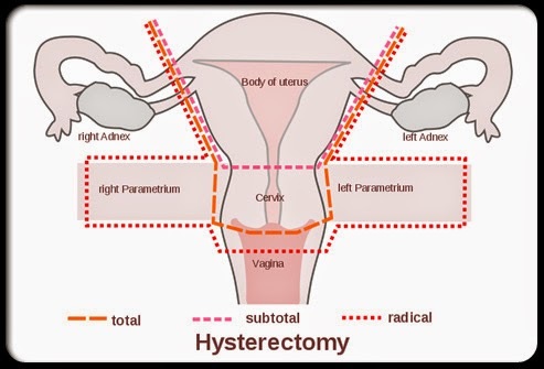 emale sexual function after hysterectomy