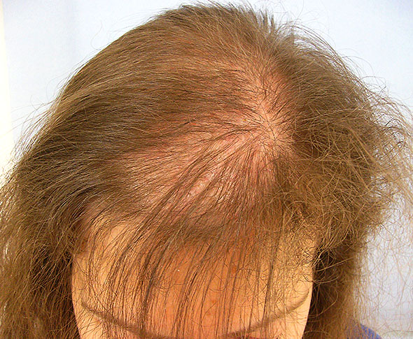 hair loss, mitochondria and thyroid