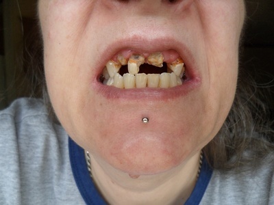 Cipro Tooth Damage