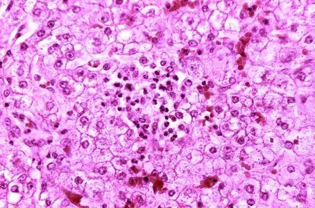 Reye's syndrome and thiamine