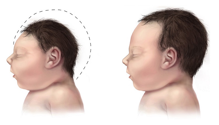 maternal thiamine deficiency microcephaly