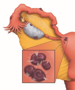 Endometriosis-adhesions