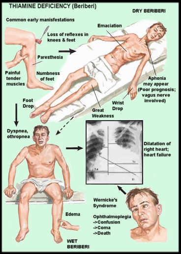 Thiamine deficiency beriberi in America