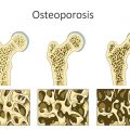 lupron osteoporosis