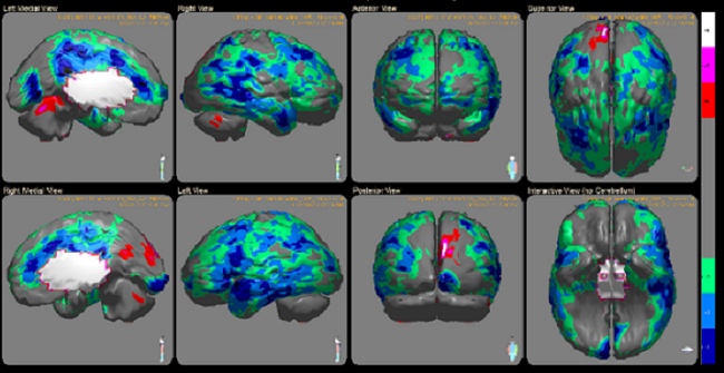 CF spect scans