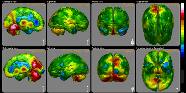 An Overview of Lexapro for Mental Health Conditions