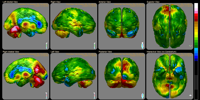 Cerebral cortex after long term Lexapro