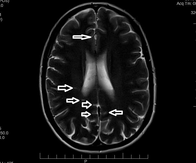 White matter lesions post Lupron