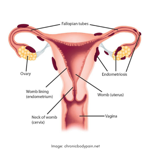 Uterus - endometrisosi