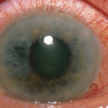 glaucoma dysautonomia