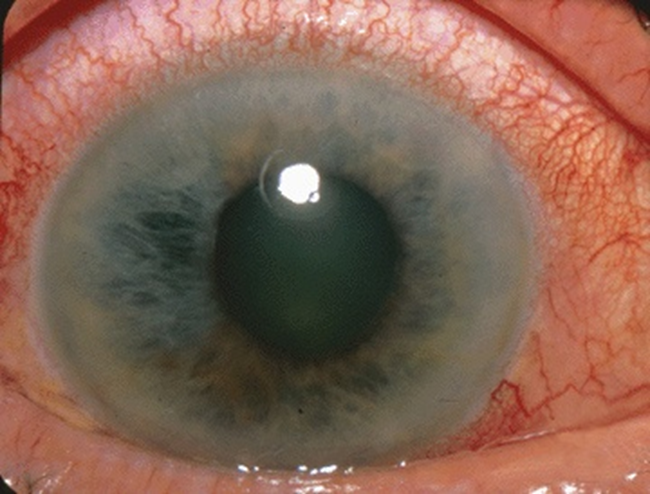 glaucoma dysautonomia