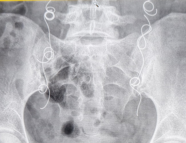 pelvic congestion hormonal birth control