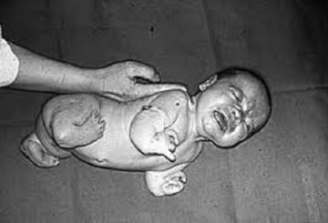 thalidomide