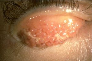 Vernal Keratoconjunctivitis