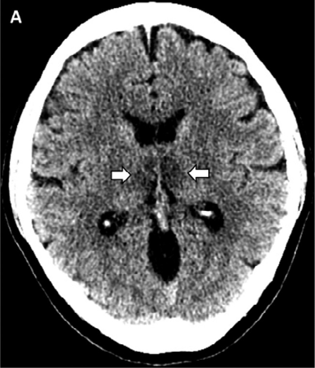 Covid encephalitis