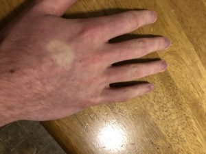 Peripheral circulation issues from functional dysautonomia.