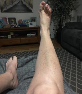 What my legs look like now