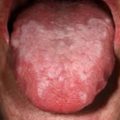 oral lichen planus