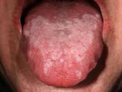 oral lichen planus