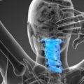 craniocervical instability