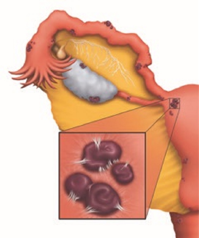 Endometriosis adhesions 
