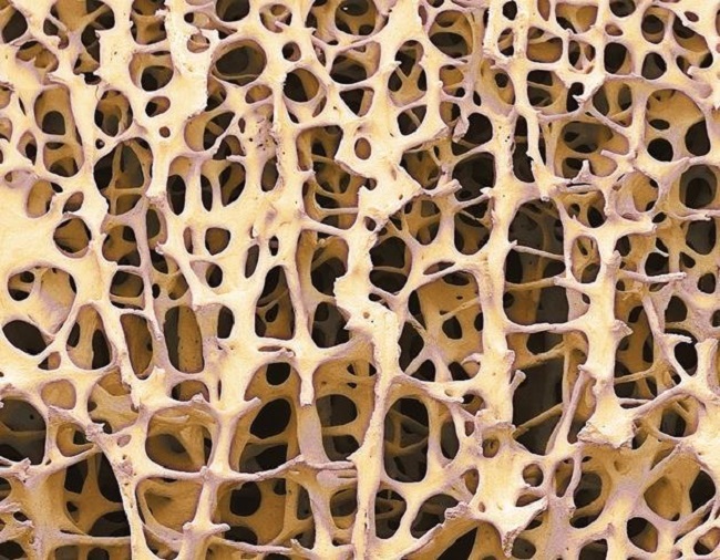 osteoporosis