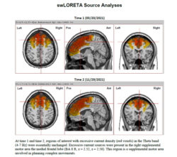 Lexapro Toxic Encephalopathy