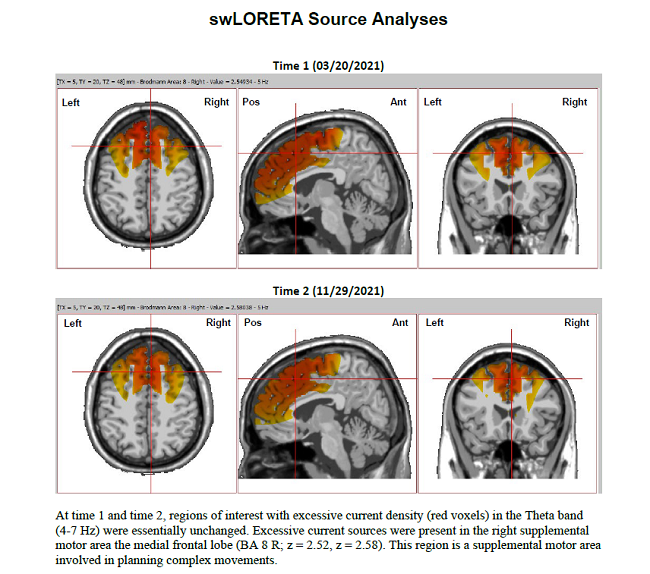 Lexapro Toxic Encephalopathy