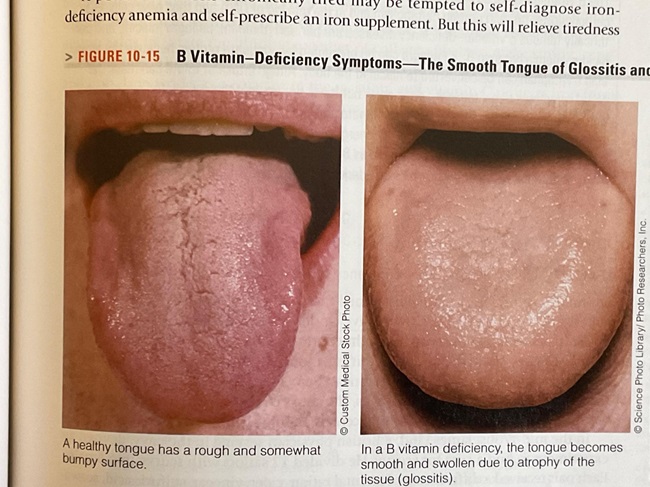 tongue vitamin B deficiency